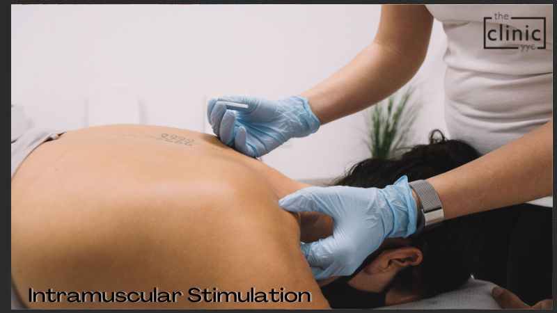 Intramuscular Stimulation  Calgary Acupuncture Clinic