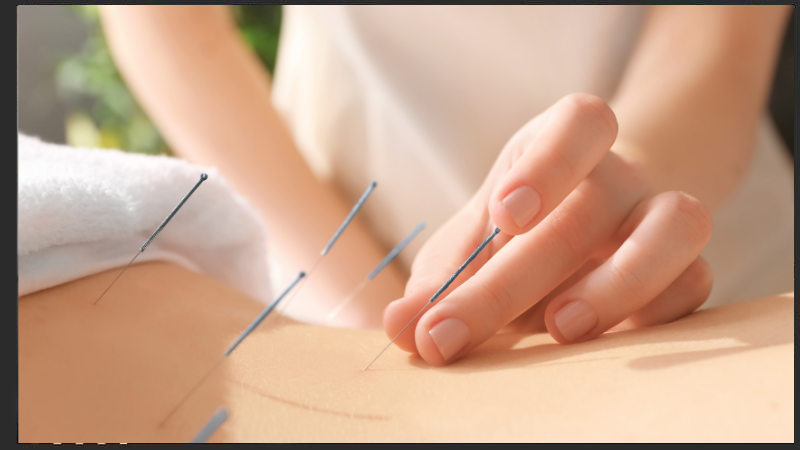 Why You Should Consider Acupuncture Therapy to Relieve Discomfort